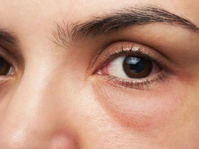 Sưng mắt khi ngủ dậy có phải dấu hiệu suy thận?