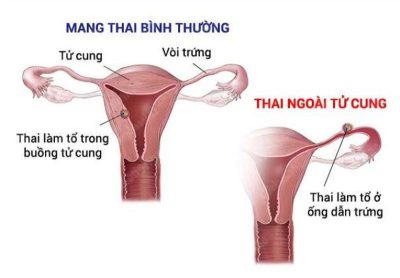 Vỡ thai ngoài tử cung do chủ quan: Bác sĩ chuyên khoa nói gì?