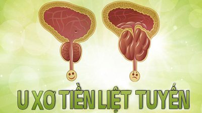 Người lớn tuổi bị u xơ tuyến tiền liệt có phẫu thuật được không?