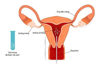 IUI – Bơm tinh trùng vào buồng tử cung