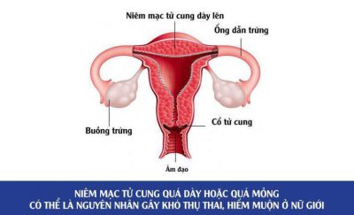 Huyết tương giàu tiểu cầu – vũ khí giúp cải thiện độ dày niêm mạc tử cung