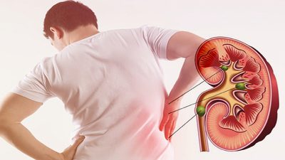 Những dấu hiệu cẩn trọng báo hiệu có sỏi trong thận