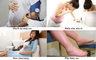 Nguy cơ tiền sản giật ở mẹ bầu
