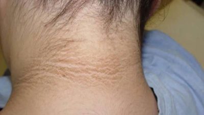 Trẻ béo phì có vệt đen vùng cổ, có đáng lo?