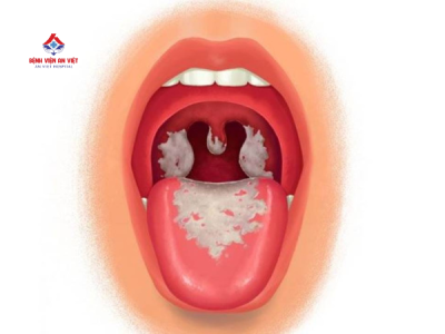 Bệnh bạch hầu có dễ lây không và lây qua những đường nào?