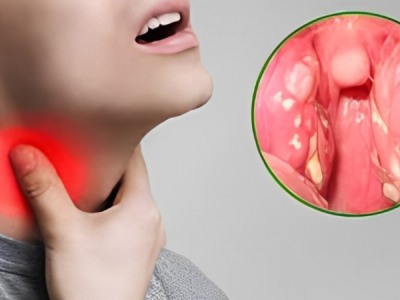 Cách phân biệt bệnh bạch hầu và viêm họng, viêm amidan