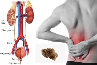 Những triệu chứng thường gặp của sỏi thận