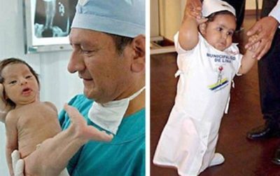 Hội chứng ‘nàng tiên cá’ ở thai nhi là gì?