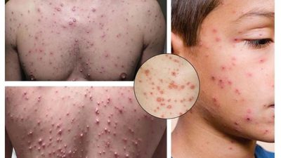 Bệnh thủy đậu lây qua những con đường nào?