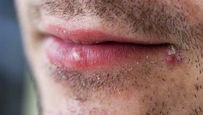 Herpes sinh dục ở nam giới có triệu chứng gì?