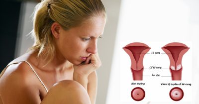 Viêm lộ tuyến cổ tử cung có nguy hiểm không?
