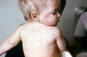 Những biến chứng nguy hiểm của bệnh sởi ở trẻ