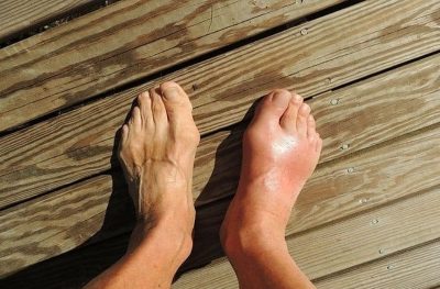 Những yếu tố làm tăng nguy cơ mắc bệnh gout