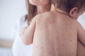 Những dấu hiệu sớm cảnh báo bệnh thủy đậu