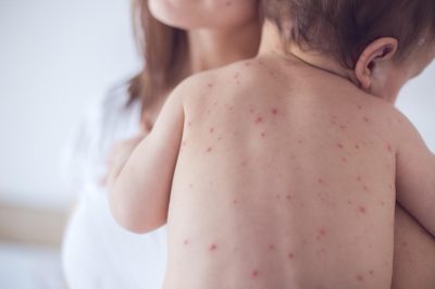 Những dấu hiệu sớm cảnh báo bệnh thủy đậu