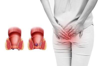 Bệnh trĩ: Nguyên nhân, triệu chứng thế nào?