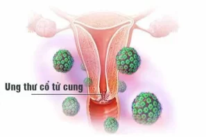 Mối Đe Dọa Từ Ung Thư Cổ Tử Cung