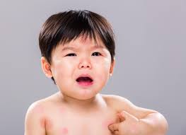Dị Ứng Thực Phẩm Mùa Hè Ở Trẻ Nhỏ – Cha Mẹ Nên Cẩn Trọng