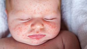 Bé Bị Rôm Sảy, Nổi Mẩn Ngứa Vào Hè: Nguyên Nhân & Cách Xử Lý An Toàn