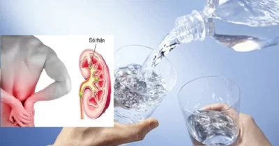 Uống ít nước có gây sỏi thận hay không?
