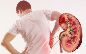 Suy thận cấp vì sỏi thận: Tình trạng không thể xem nhẹ