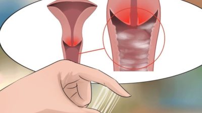 Viêm Nhiễm Phụ Khoa Tái Đi Tái Lại – Cách Điều Trị Dứt Điểm?