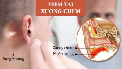 Viêm tai xương chũm là gì, triệu chứng thế nào?
