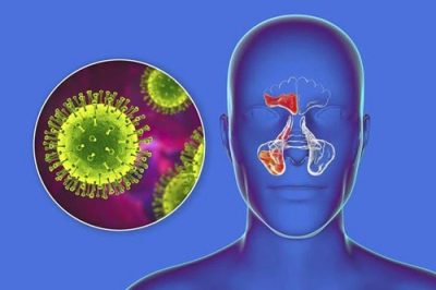 Viêm xoang do nấm là gì, có nguy hiểm không?