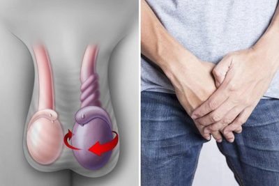 Xoắn tinh hoàn: Những dấu hiệu cần nhập viện ngay