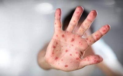 Những con đường lây truyền của bệnh tay chân miệng