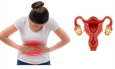 Những điều cần biết về buồng trứng đa nang