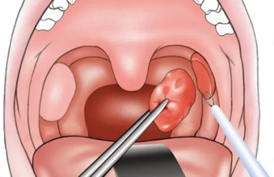 Cắt Amidan Cho Bé – Có Nên Không? Lợi Ích Và Rủi Ro Cha Mẹ Cần Biết