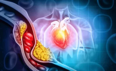 Cholesterol Cao – Nguy Hiểm Thế Nào Và Làm Sao Để Giảm?