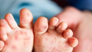 Trẻ bị tay chân miệng: Khi nào điều trị ở nhà và khi nào nhập viện?
