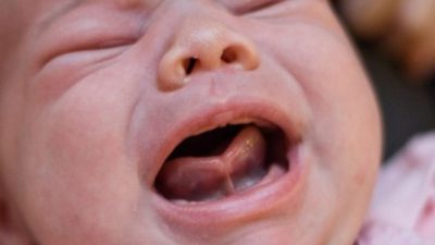 Dính Thắng Lưỡi Ở Trẻ, Ảnh Hưởng Sức Khỏe Như Thế Nào?