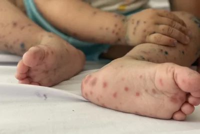 Chăm sóc trẻ bị tay chân miệng thế nào?