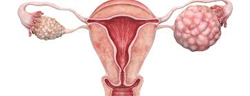 Buồng Trứng Đa Nang – Nguyên Nhân Hàng Đầu Gây Rối Loạn Kinh Nguyệt Và Vô Sinh