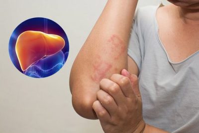 Một số dấu hiệu cảnh báo tình trạng men gan cao
