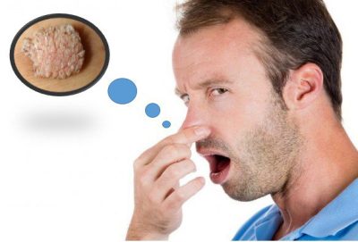 Nguyên nhân bất ngờ khiến người đàn ông bị sùi mào gà ở mũi