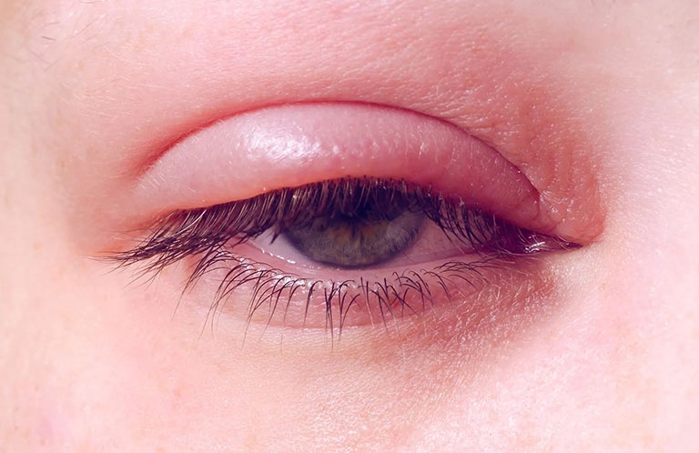 Viêm bờ mi mắt là một trong những bệnh thường gặp ở mắt. Ảnh minh họa