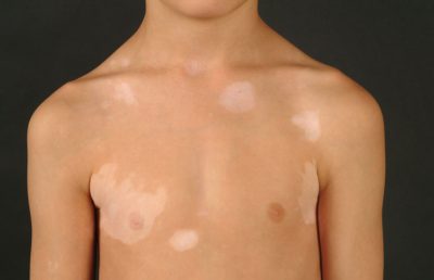 Lang ben là bệnh gì, có nguy hiểm không?