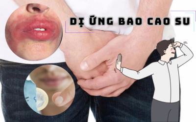 Ngứa, nổi mẩn… khi sử dụng bao cao su là bệnh gì?