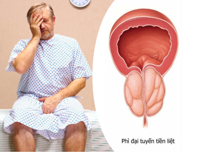 Phì đại tuyến tiền liệt: Nỗi lo của nam giới trung niên