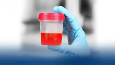 Nước tiểu lẫn máu: Dấu hiệu cảnh báo viêm cầu thận