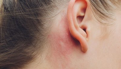 Những dấu hiệu nhận biết bệnh chàm tai