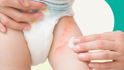 Hăm tã vì sao dễ gặp hơn vào mùa đông?