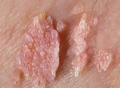 Sùi mào gà: Bệnh lý lây qua đường tình dục ám ảnh nhiều người