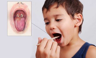 Bệnh bạch hầu và những điều cần biết