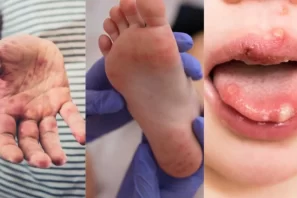 Tay chân miệng: Bệnh lý khiến nhiều phụ huynh lo lắng