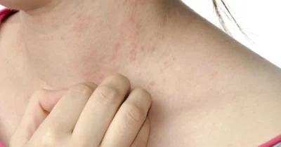 Những dấu hiệu cảnh báo bệnh thận